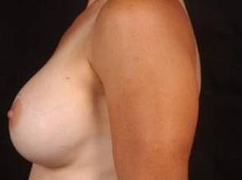 Breast Augmentation 410 Before & After Gallery - Patient 342084 - Image 4