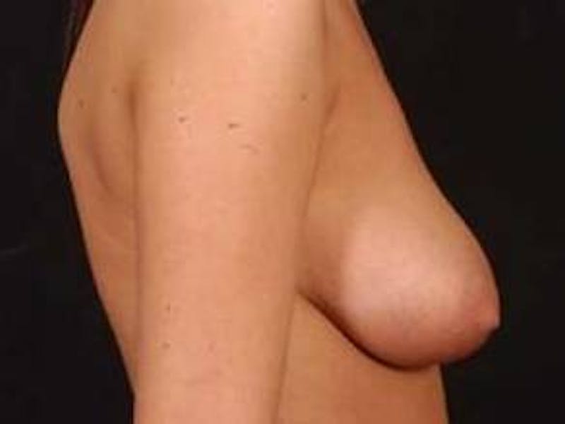 Breast Asymmetry Correction Before & After Gallery - Patient 993336 - Image 3