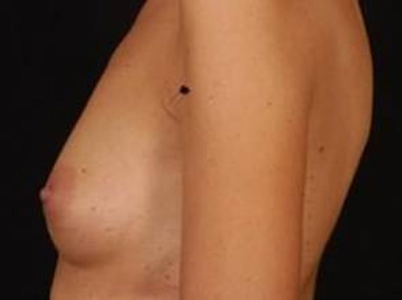Breast Augmentation 410 Before & After Gallery - Patient 300083 - Image 3