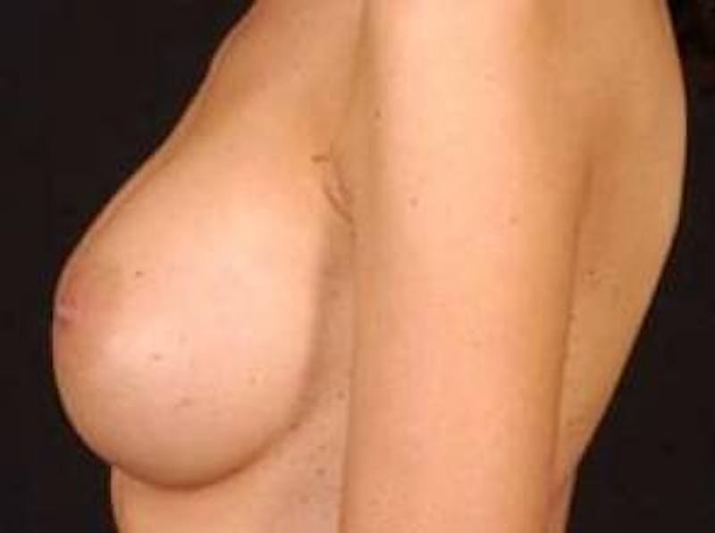 Breast Augmentation 410 Before & After Gallery - Patient 300083 - Image 4