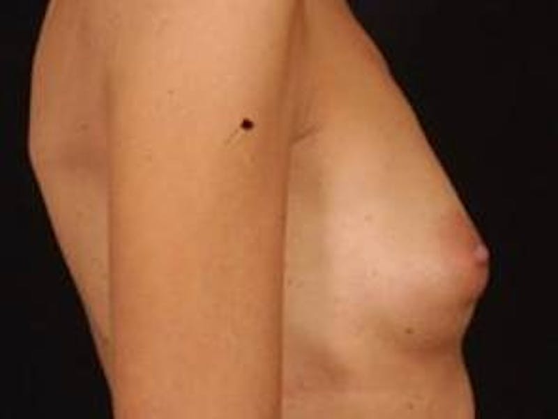 Breast Augmentation 410 Before & After Gallery - Patient 300083 - Image 5