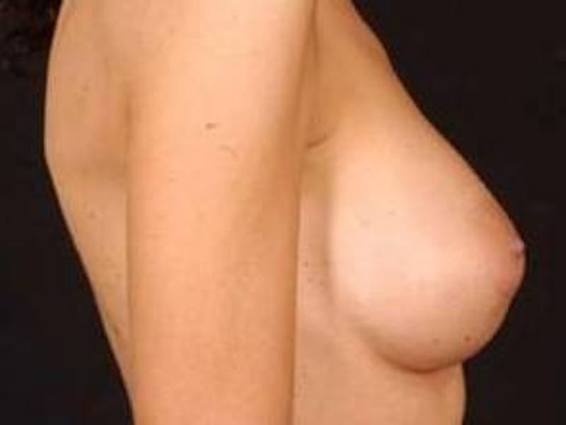 Breast Augmentation 410 Before & After Gallery - Patient 300083 - Image 6
