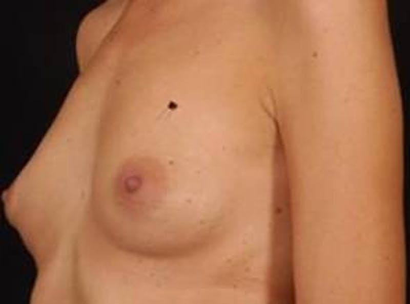Breast Augmentation 410 Before & After Gallery - Patient 300083 - Image 7