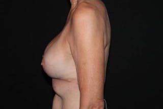 Aesthetic Breast Revision Before & After Gallery - Patient 329086 - Image 6