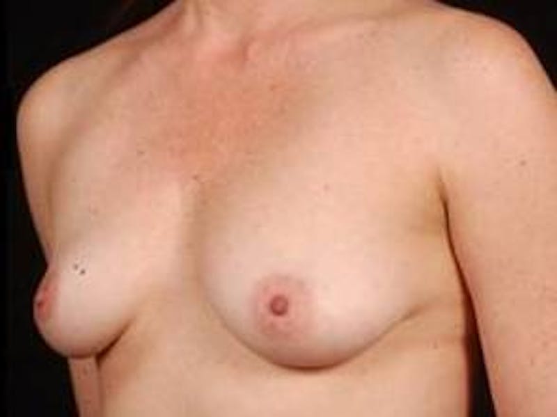 Breast Asymmetry Correction Before & After Gallery - Patient 257121 - Image 3
