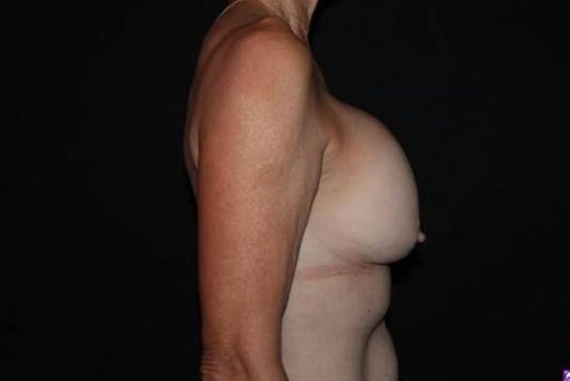 Aesthetic Breast Revision Before & After Gallery - Patient 329086 - Image 9
