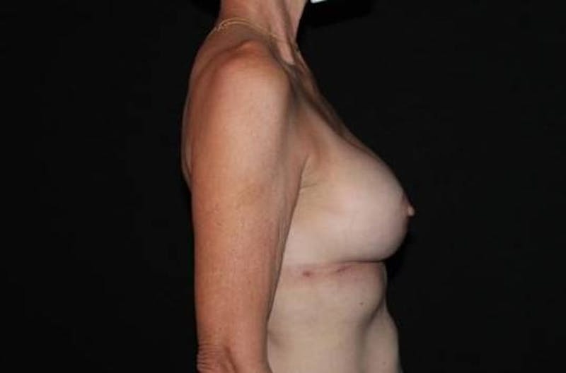 Aesthetic Breast Revision Before & After Gallery - Patient 329086 - Image 10