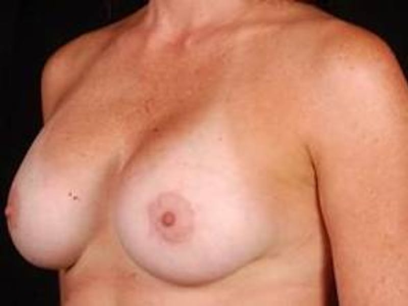 Breast Asymmetry Correction Before & After Gallery - Patient 257121 - Image 4