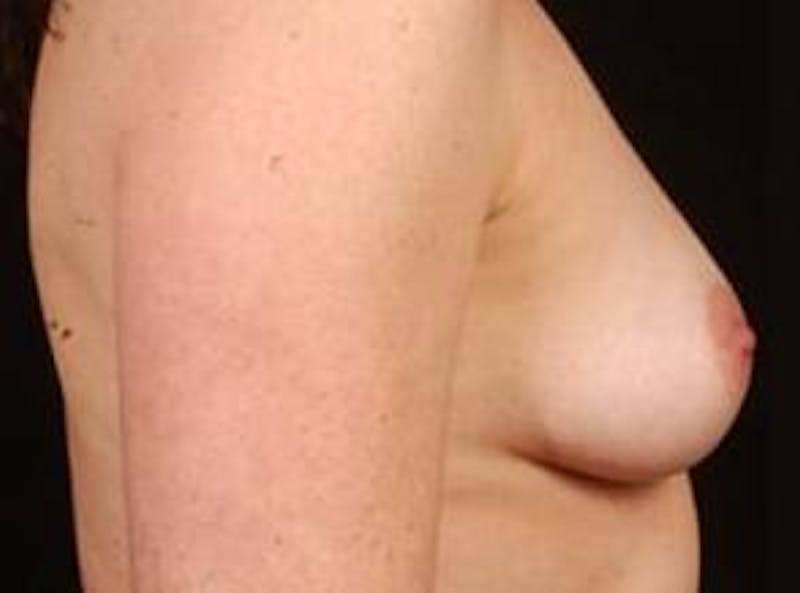 Breast Asymmetry Correction Before & After Gallery - Patient 257121 - Image 5