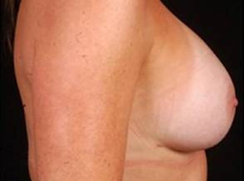 Breast Asymmetry Correction Before & After Gallery - Patient 257121 - Image 6