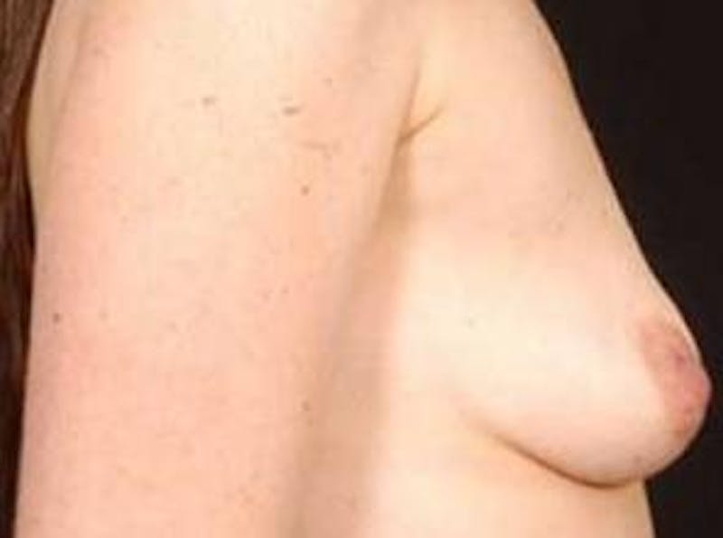 Breast Augmentation 410 Before & After Gallery - Patient 378964 - Image 5