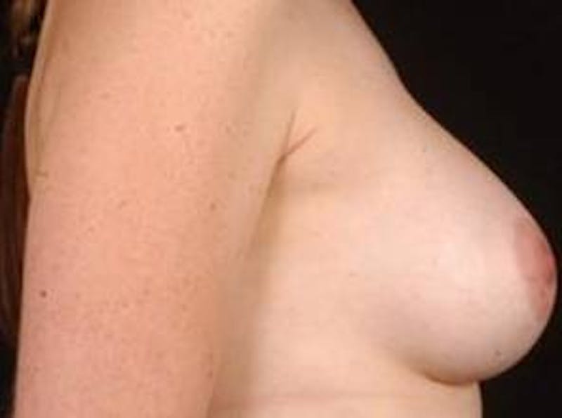 Breast Augmentation 410 Before & After Gallery - Patient 378964 - Image 6