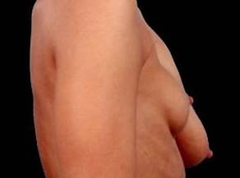 Breast Asymmetry Correction Before & After Gallery - Patient 329199 - Image 3