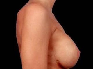 Breast Asymmetry Correction Before & After Gallery - Patient 329199 - Image 4
