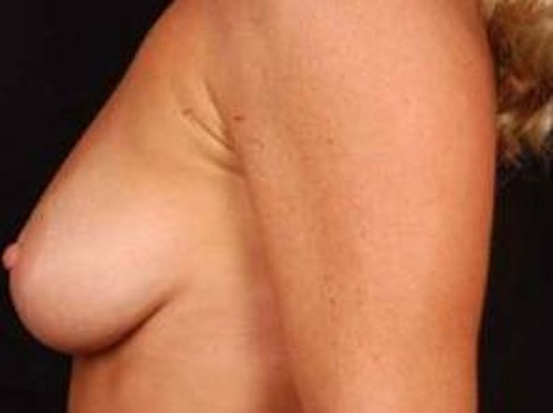 Breast Augmentation 410 Before & After Gallery - Patient 367594 - Image 3