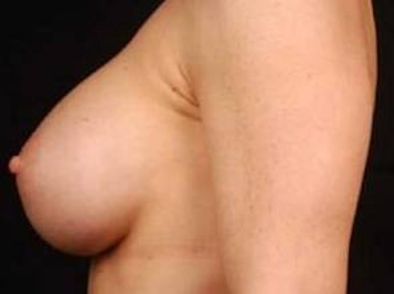 Breast Augmentation 410 Before & After Gallery - Patient 367594 - Image 4