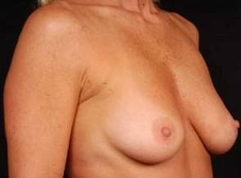 Breast Augmentation 410 Before & After Gallery - Patient 367594 - Image 5