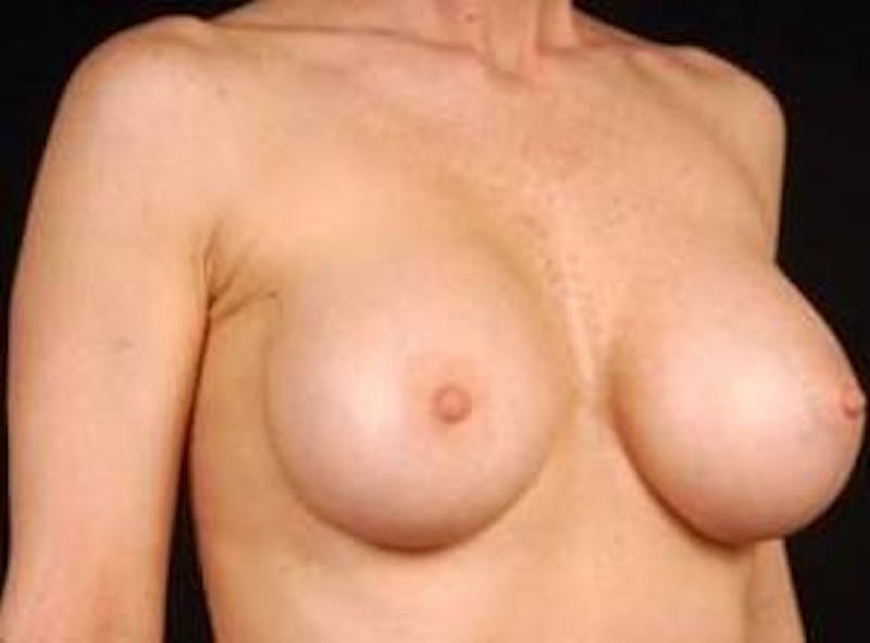Breast Augmentation 410 Before & After Gallery - Patient 367594 - Image 6