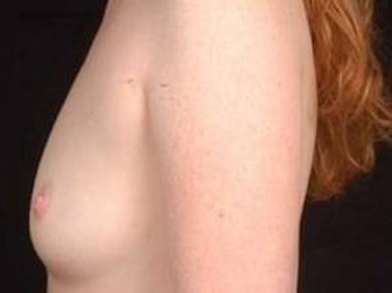 Breast Augmentation 410 Before & After Gallery - Patient 462614 - Image 3