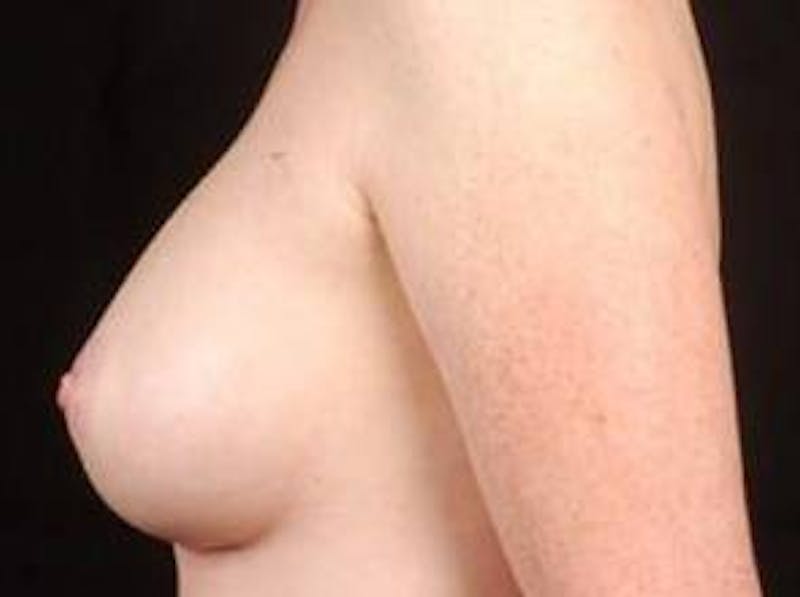 Breast Augmentation 410 Before & After Gallery - Patient 462614 - Image 4