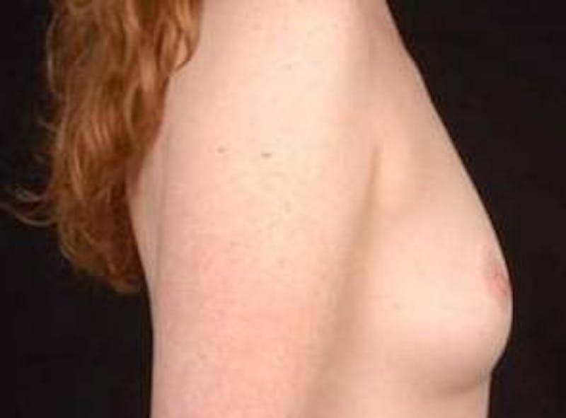 Breast Augmentation 410 Before & After Gallery - Patient 462614 - Image 5