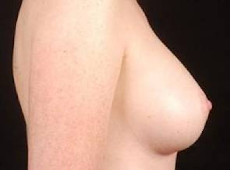 Breast Augmentation 410 Before & After Gallery - Patient 462614 - Image 6