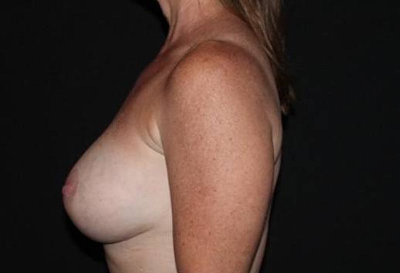 Aesthetic Breast Revision Before & After Gallery - Patient 293059 - Image 5