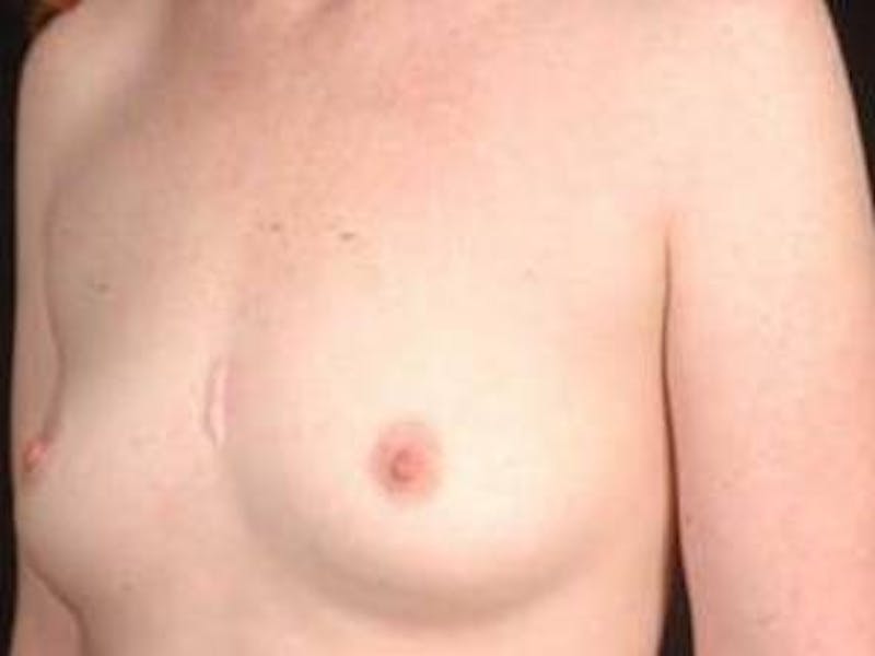 Breast Augmentation 410 Before & After Gallery - Patient 462614 - Image 7