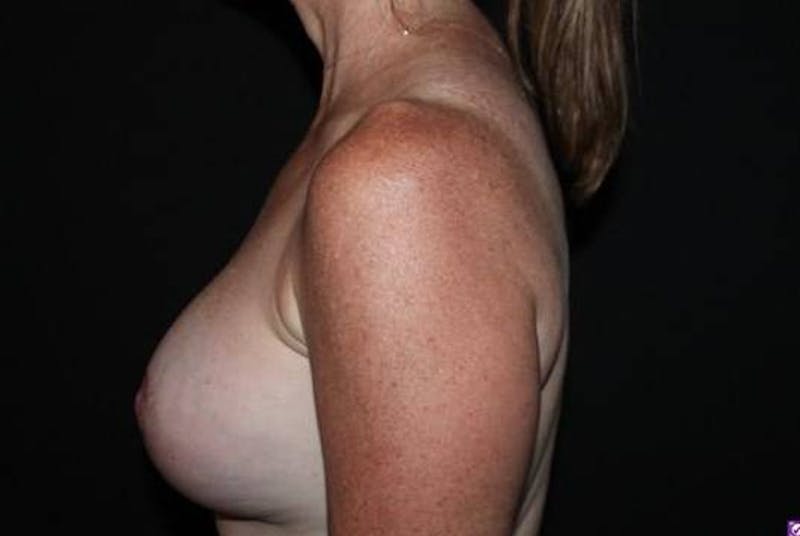 Aesthetic Breast Revision Before & After Gallery - Patient 293059 - Image 6