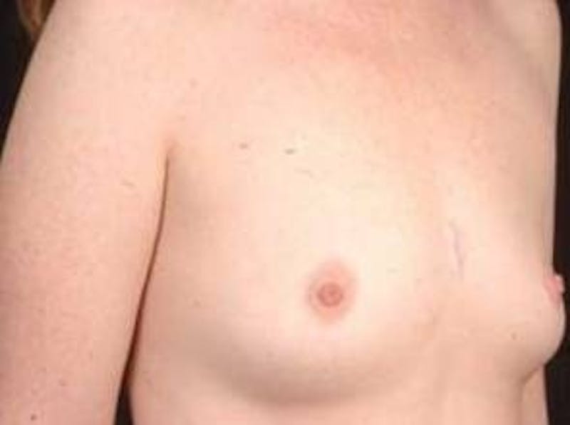 Breast Augmentation 410 Before & After Gallery - Patient 462614 - Image 9