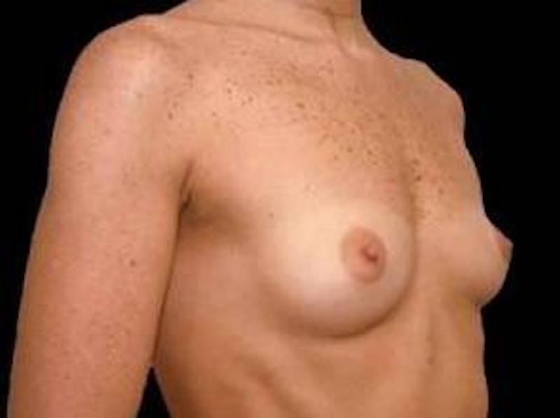 Breast Augmentation 410 Before & After Gallery - Patient 221414 - Image 3