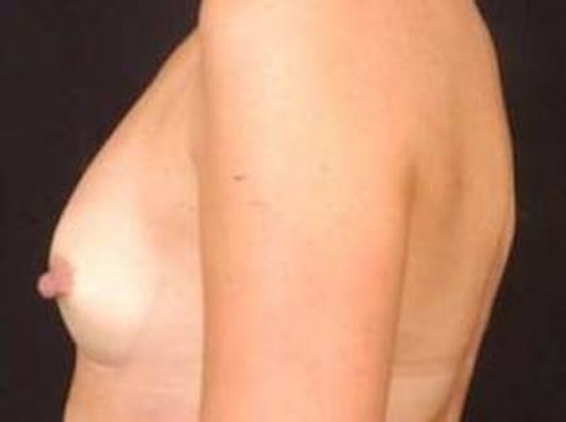 Breast Augmentation 410 Before & After Gallery - Patient 161384 - Image 3