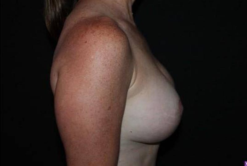Aesthetic Breast Revision Before & After Gallery - Patient 293059 - Image 10