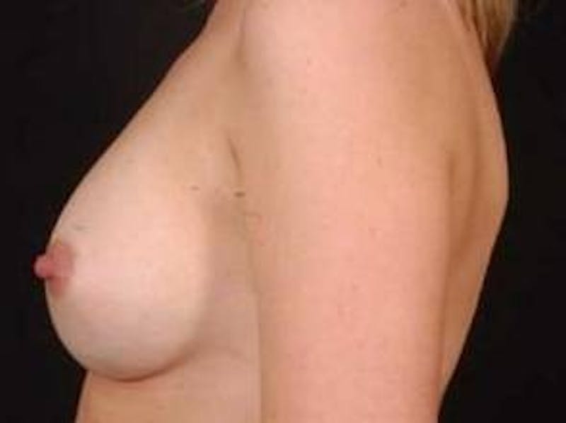 Breast Augmentation 410 Before & After Gallery - Patient 161384 - Image 4