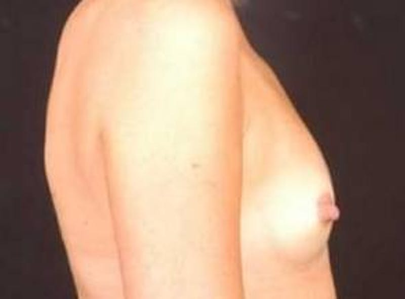 Breast Augmentation 410 Before & After Gallery - Patient 161384 - Image 5