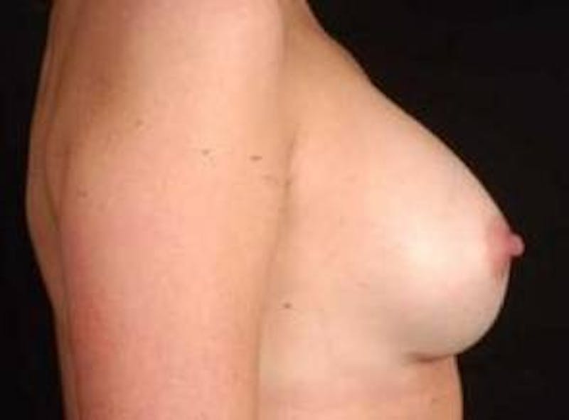 Breast Augmentation 410 Before & After Gallery - Patient 161384 - Image 6