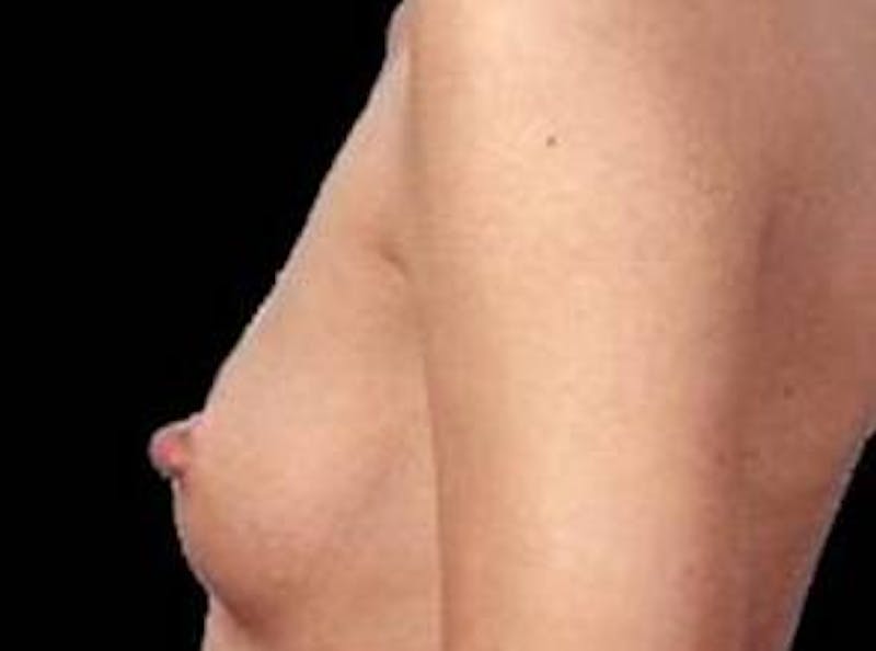 Breast Augmentation 410 Before & After Gallery - Patient 189801 - Image 3