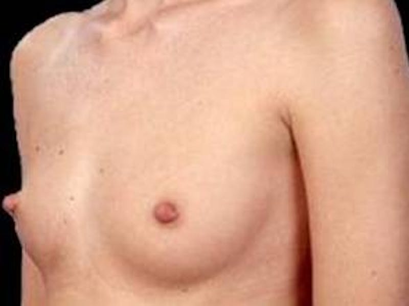 Breast Augmentation 410 Before & After Gallery - Patient 189801 - Image 5