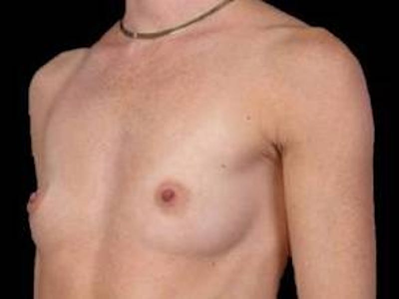 Breast Augmentation 410 Before & After Gallery - Patient 116907 - Image 3