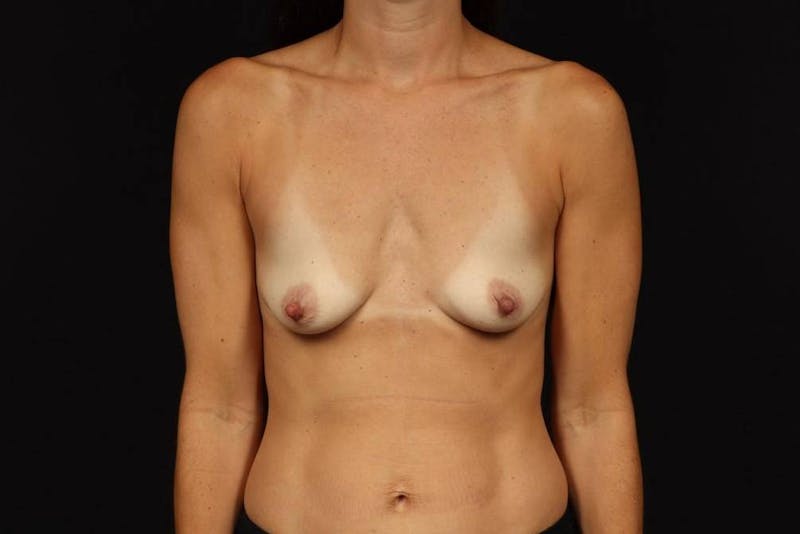Breast Augmentation Silicone Gel Before & After Gallery - Patient 282256 - Image 1