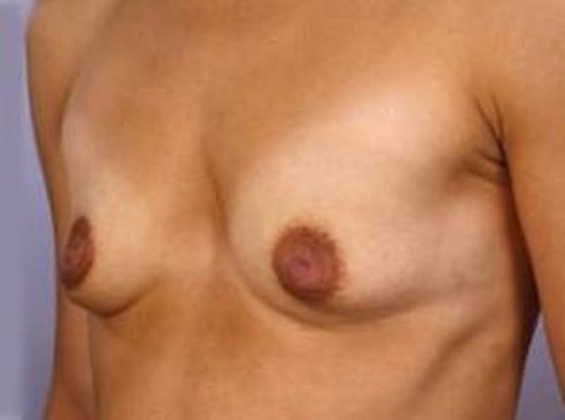 Breast Augmentation 410 Before & After Gallery - Patient 182789 - Image 3
