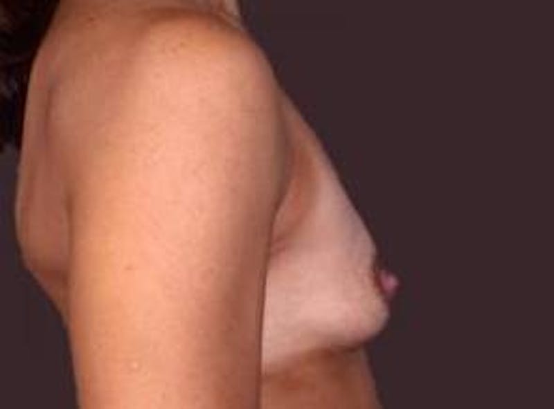 Breast Augmentation 410 Before & After Gallery - Patient 182789 - Image 5