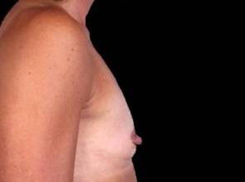 Breast Augmentation 410 Before & After Gallery - Patient 297519 - Image 3