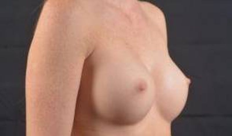 Aesthetic Breast Revision Before & After Gallery - Patient 286207 - Image 9