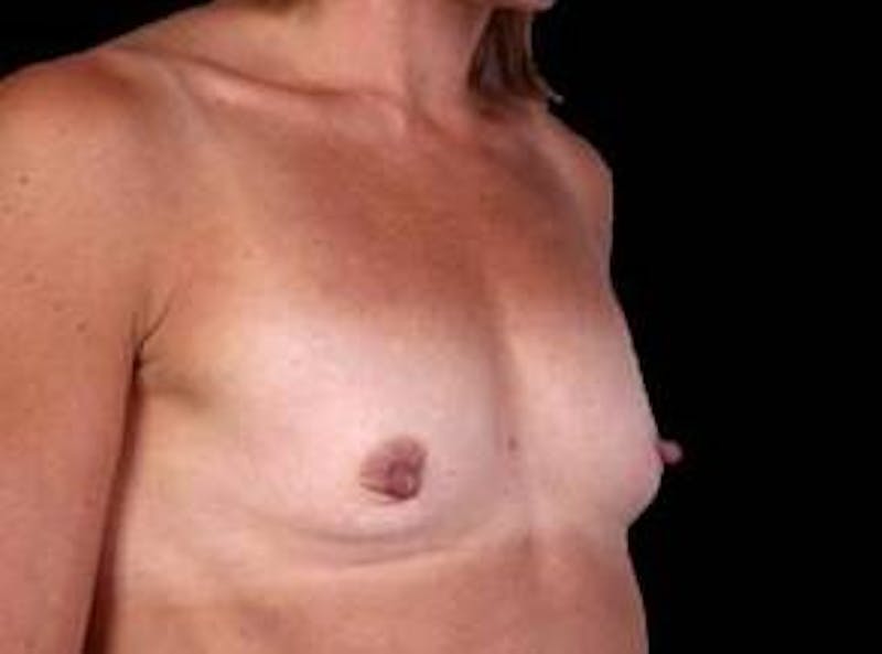 Breast Augmentation 410 Before & After Gallery - Patient 297519 - Image 5