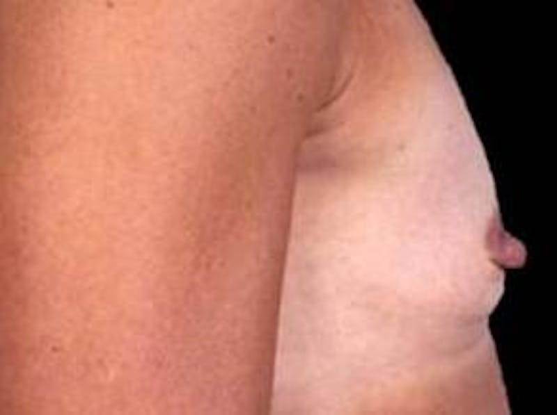 Breast Augmentation 410 Before & After Gallery - Patient 294994 - Image 3