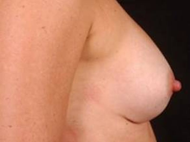 Breast Augmentation 410 Before & After Gallery - Patient 294994 - Image 4