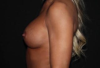 Aesthetic Breast Revision Before & After Gallery - Patient 200171 - Image 6
