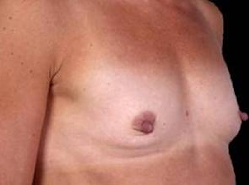 Breast Augmentation 410 Before & After Gallery - Patient 294994 - Image 5