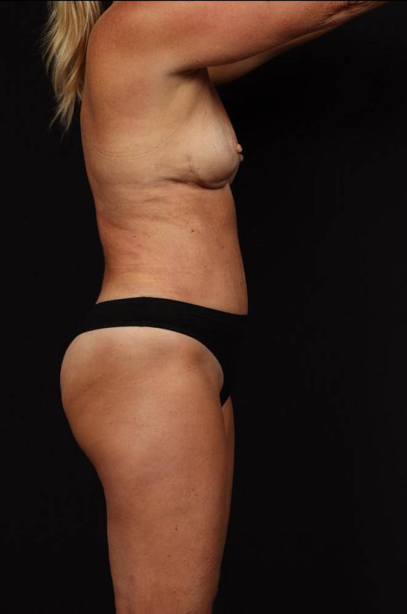 Breast Fat Grafting Before & After Gallery - Patient 132426 - Image 10